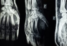 When to Start Physiotherapy after Fracture