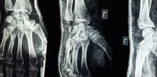 When to Start Physiotherapy after Fracture