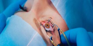 How Long Does LASIK Last? Understanding the Longevity of Your Vision Correction Lasik Surgery